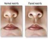 Nasal flaring.jpg